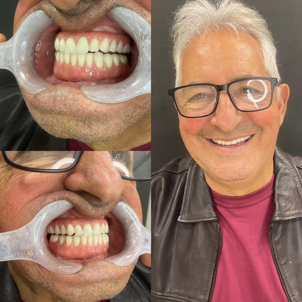 Antes e depois de reabilitação oral com implantes dentários em paciente na clínica OdontoLaf.